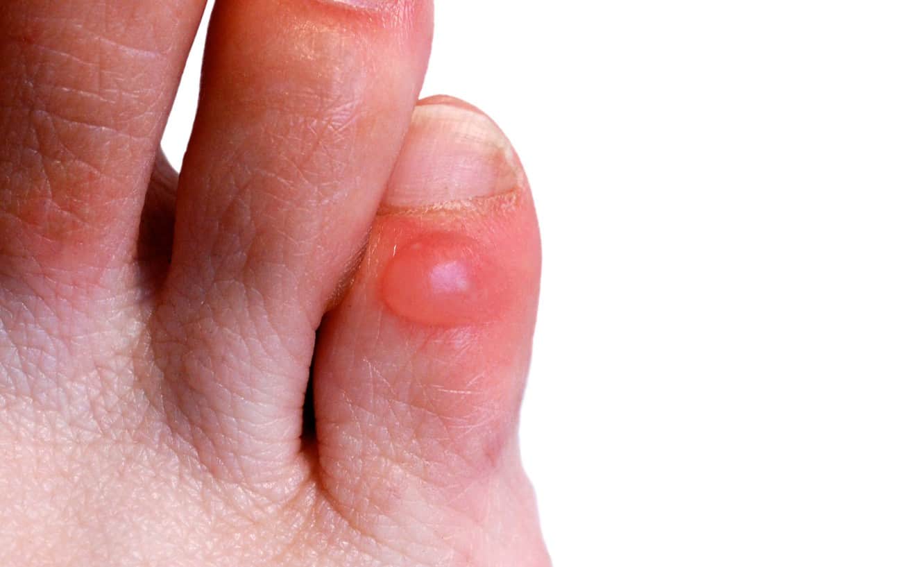 A close-up of a blister on the pinky toe.