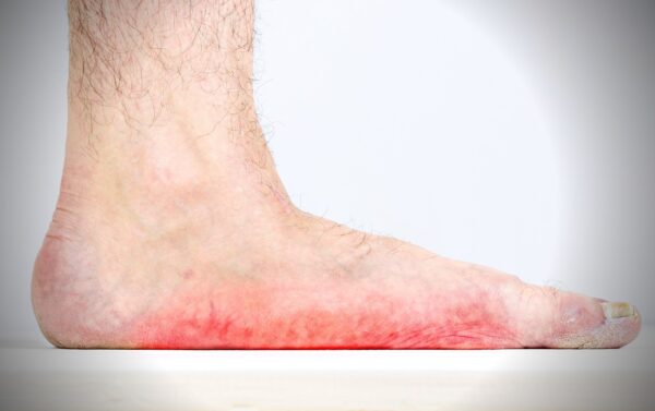 running with flat feet