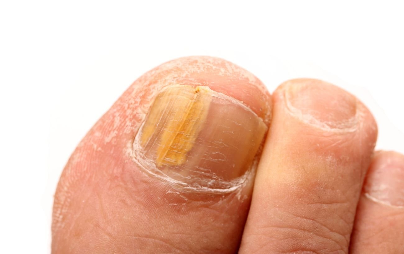 My Toenail Came Off...Now What? | Cone Health