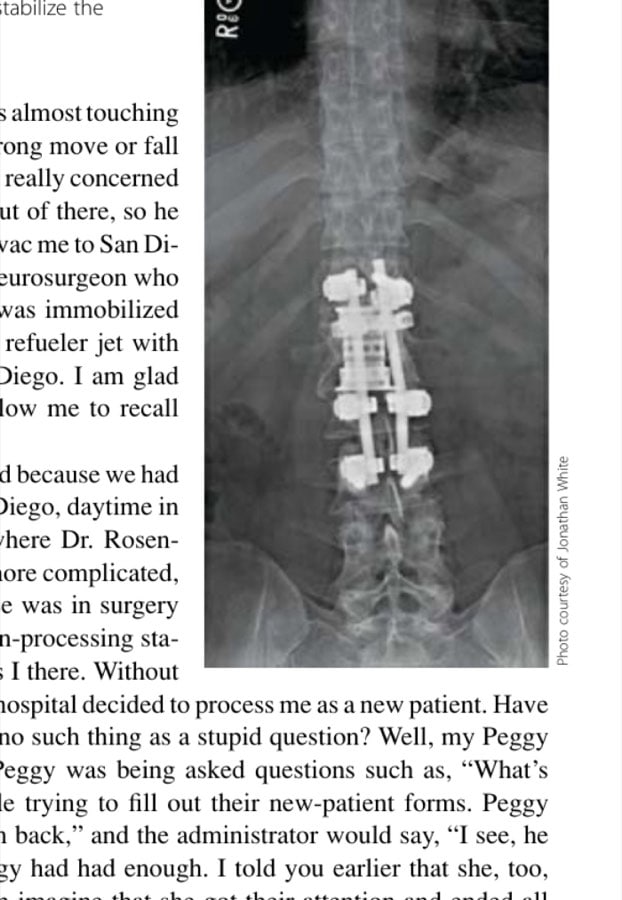 Titanium construction that CDR Robert Rosenbaum, USN, implanted to stabilize the author's spine.