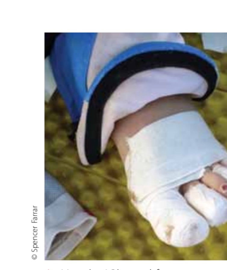 Sahara Grit 21 Mon dieu! Blistered feet: a common sight throughout MDS.
