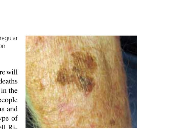 Countdown to the First Sub-2:00:00 21 This melanoma has a large size, an irregular shape, and varied coloring and occurs on sun-damaged skin.