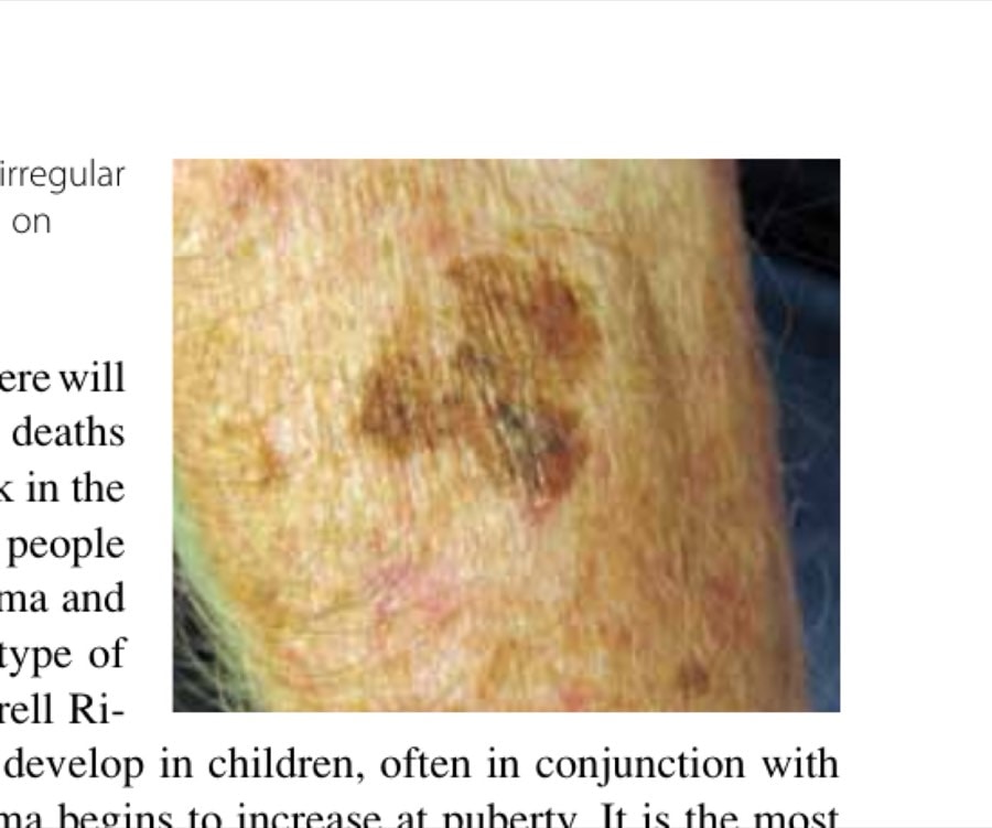 This melanoma has a large size, an irregular shape, and varied coloring and occurs on sun-damaged skin.