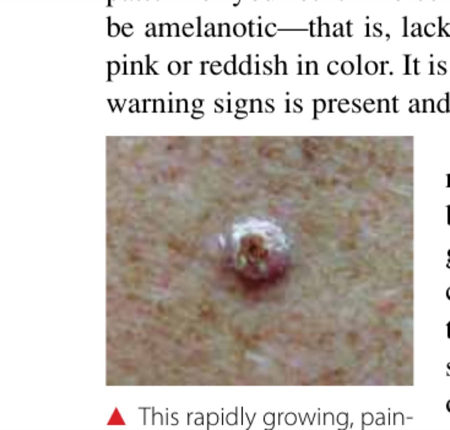This rapidly growing, painful keratotic nodule is a squamous cell carcinoma.
