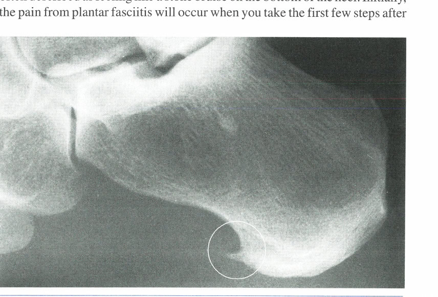 Figure 2: Heel spur