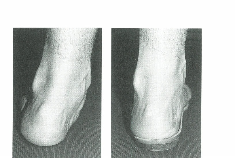 Figure 4: The overpronated foot (left) controlled with an orthotic (right)