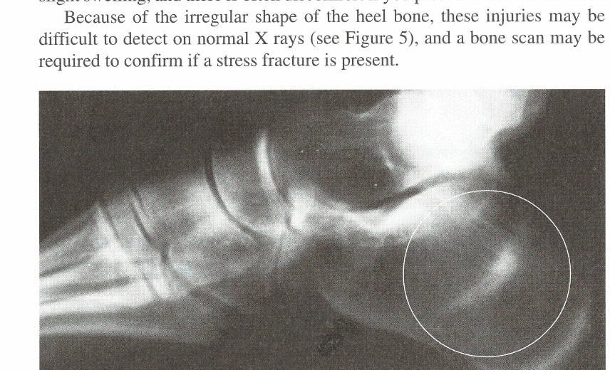 Figure 5: X ray showing a stress fracture of the heel
