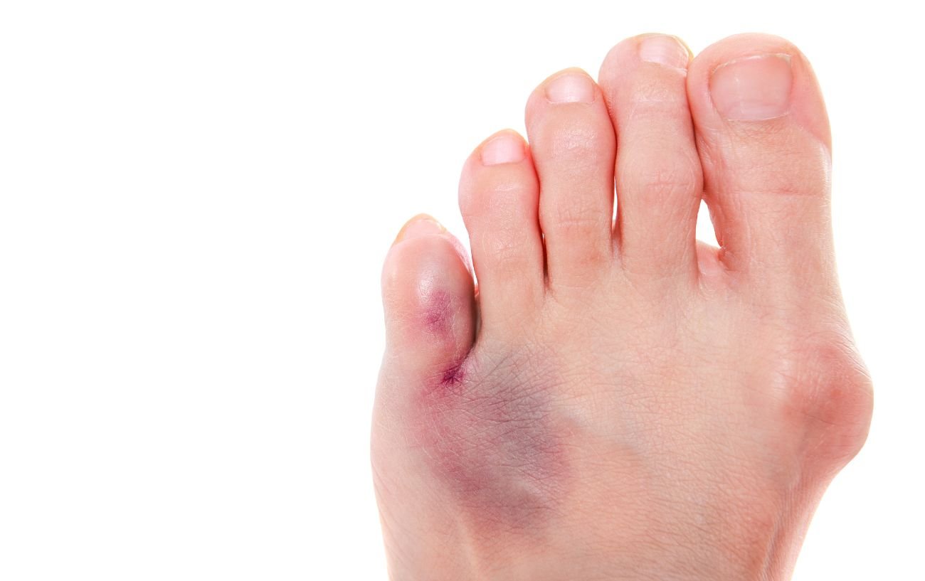 Stubbed Toe Treatment: When Do You Need To Seek Help?