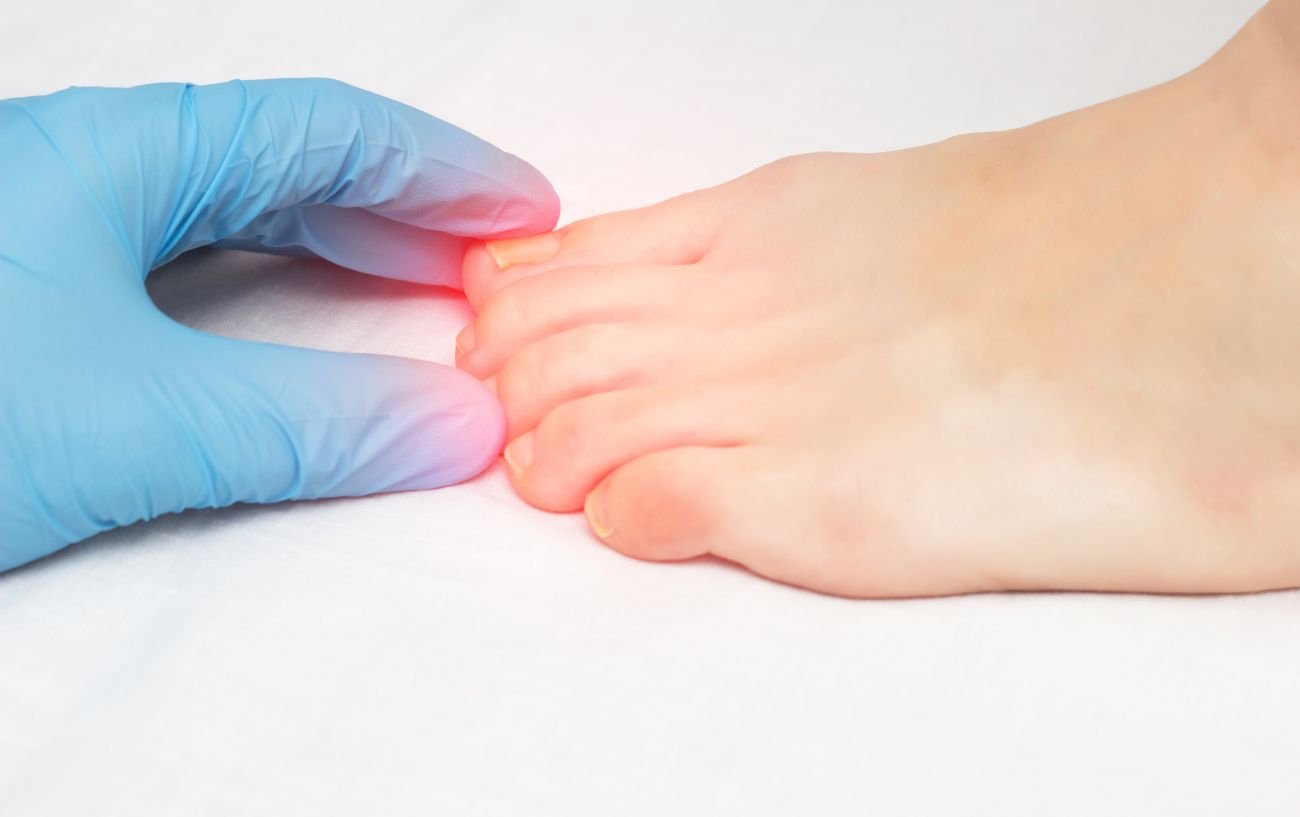 Stubbed Toe Treatment: When Do You Need To Seek Help?