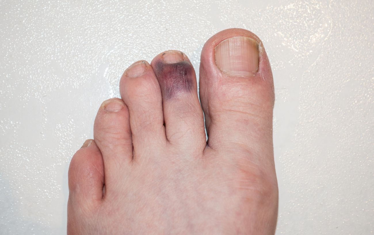 Stubbed Toe Treatment: When Do You Need To Seek Help?