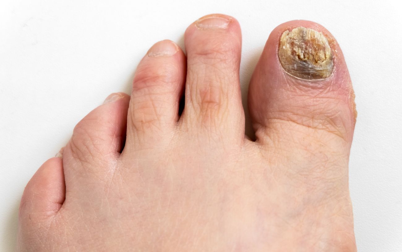 How to Treat Yellow Toenails