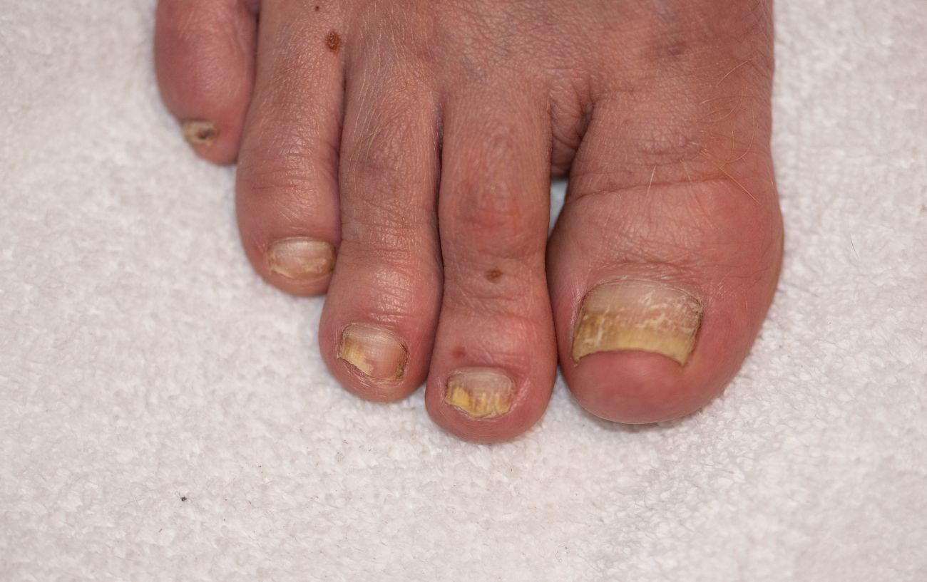 Why Are My Toenails Yellow? Here Are 4 Likely Causes