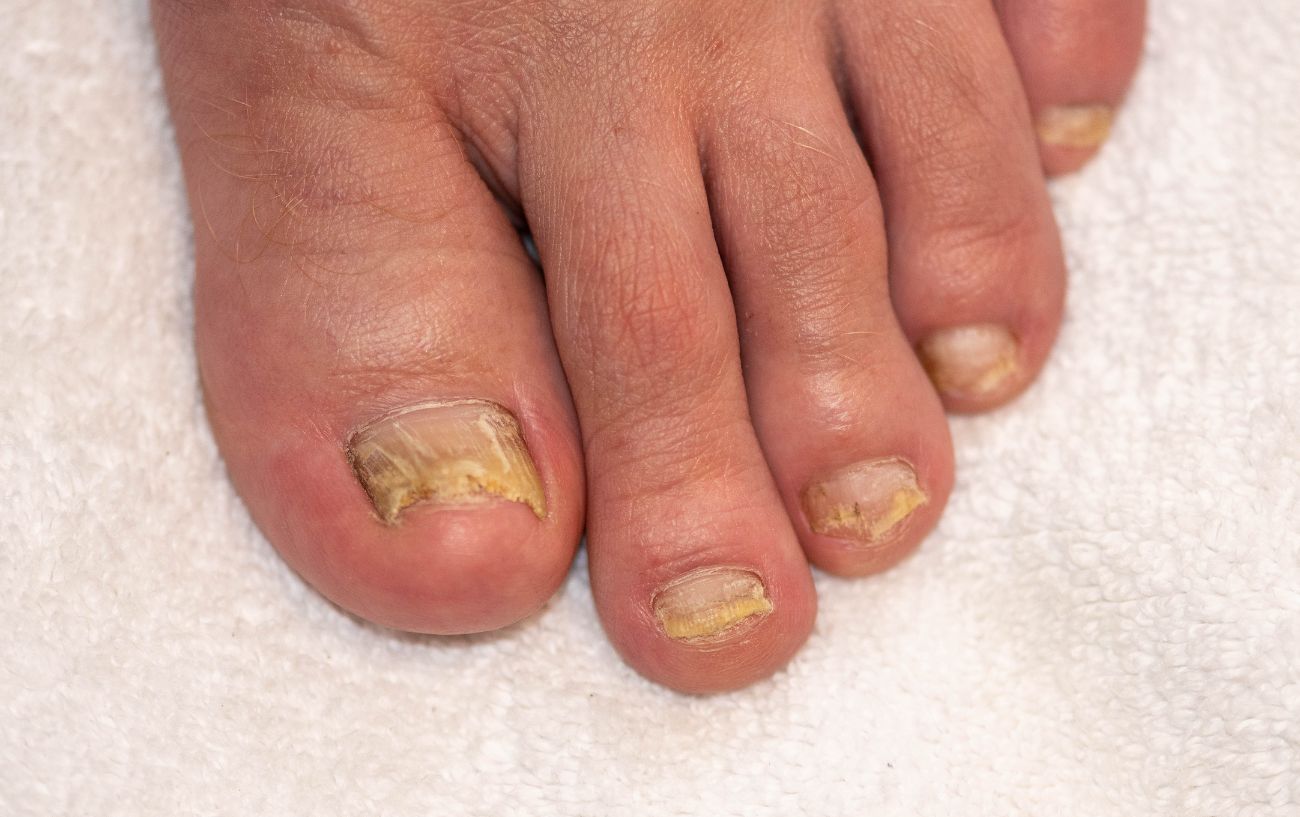 How to Treat Yellow Toenails