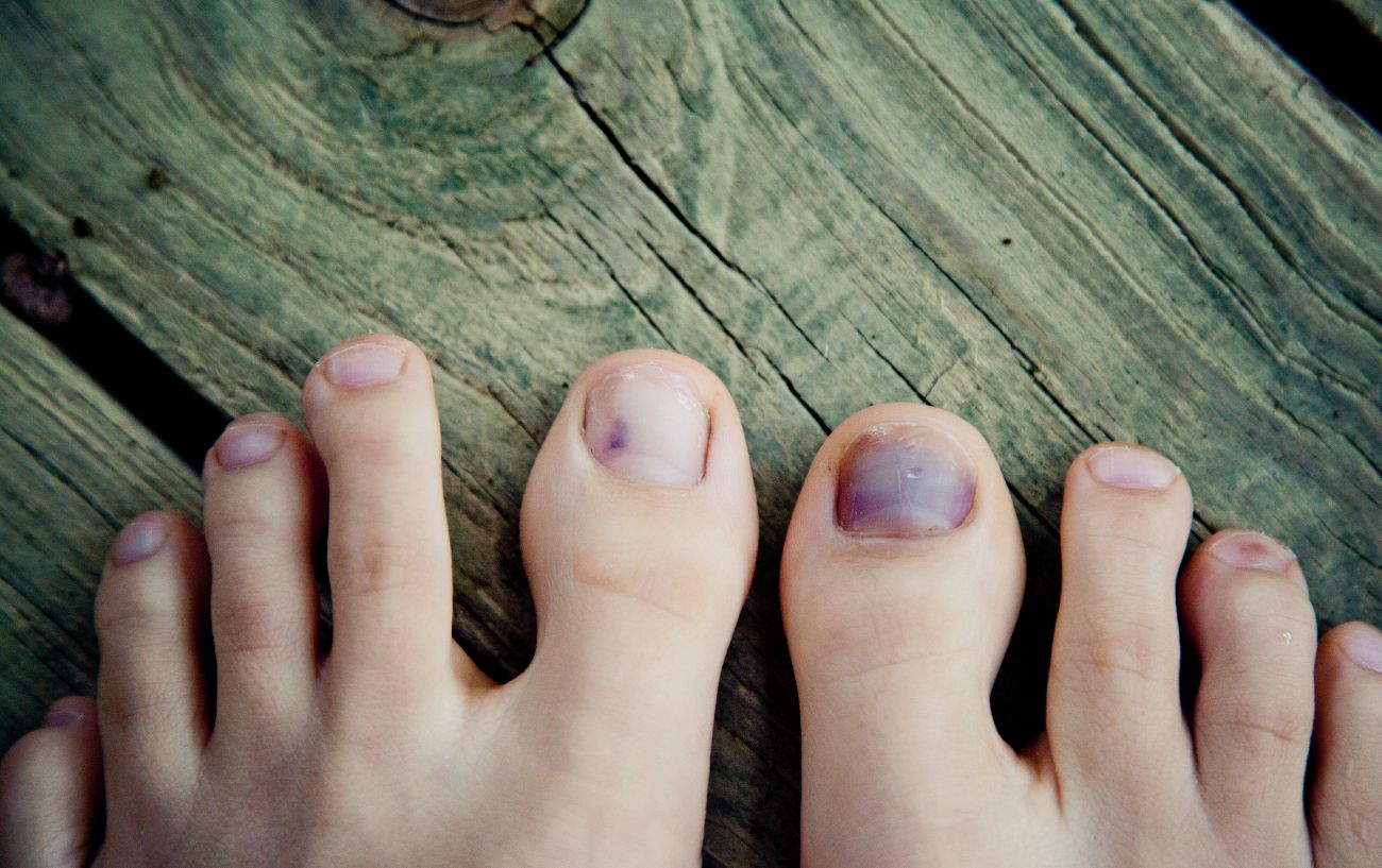 Black and blue toenails.